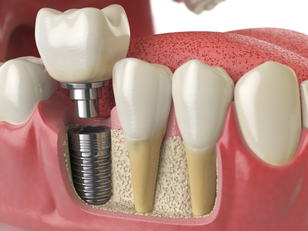 Dental implants Implant procedure Dr. Brian Valle dds Dentist in Millersville maryland