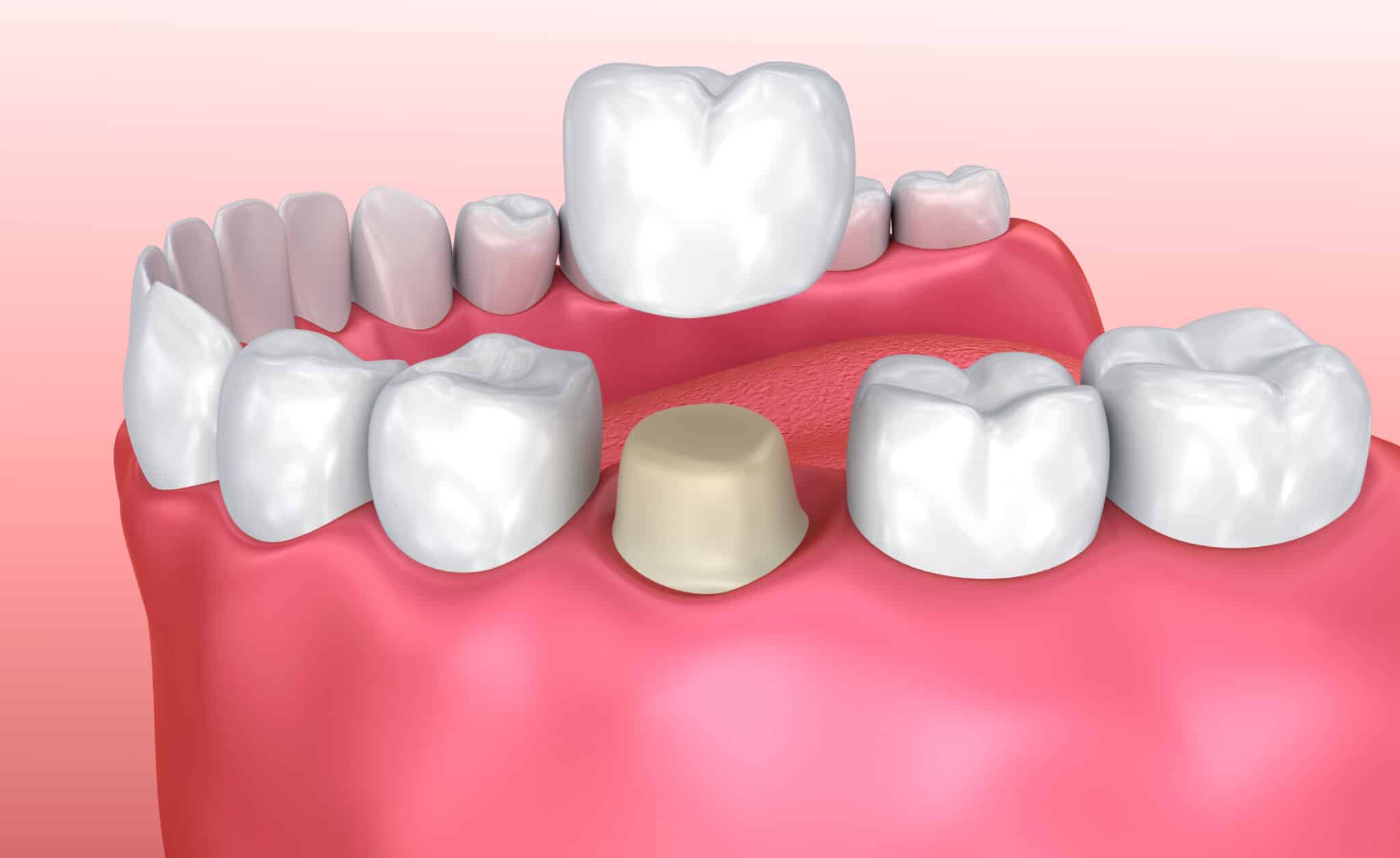 dental crowns Millersville what are dental crowns? diagram Dr. Brian Valle P. A. dentist in Millersville, MD Dr. Brian Valle