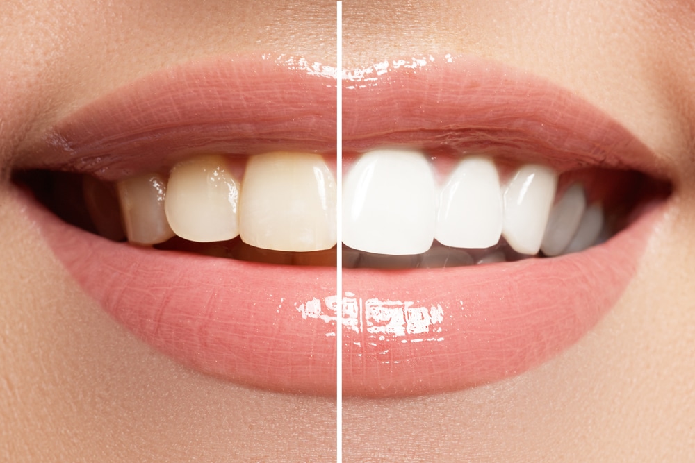 Different Ways You Can Whiten Your Teeth Dr. Brian Valle P. A. dentist in Millersville, MD Dr. Brian Valle