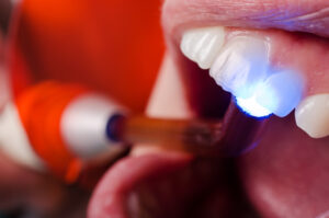 restorative dentistry Dr. Brian Valle dds Dentist in Millersville maryland